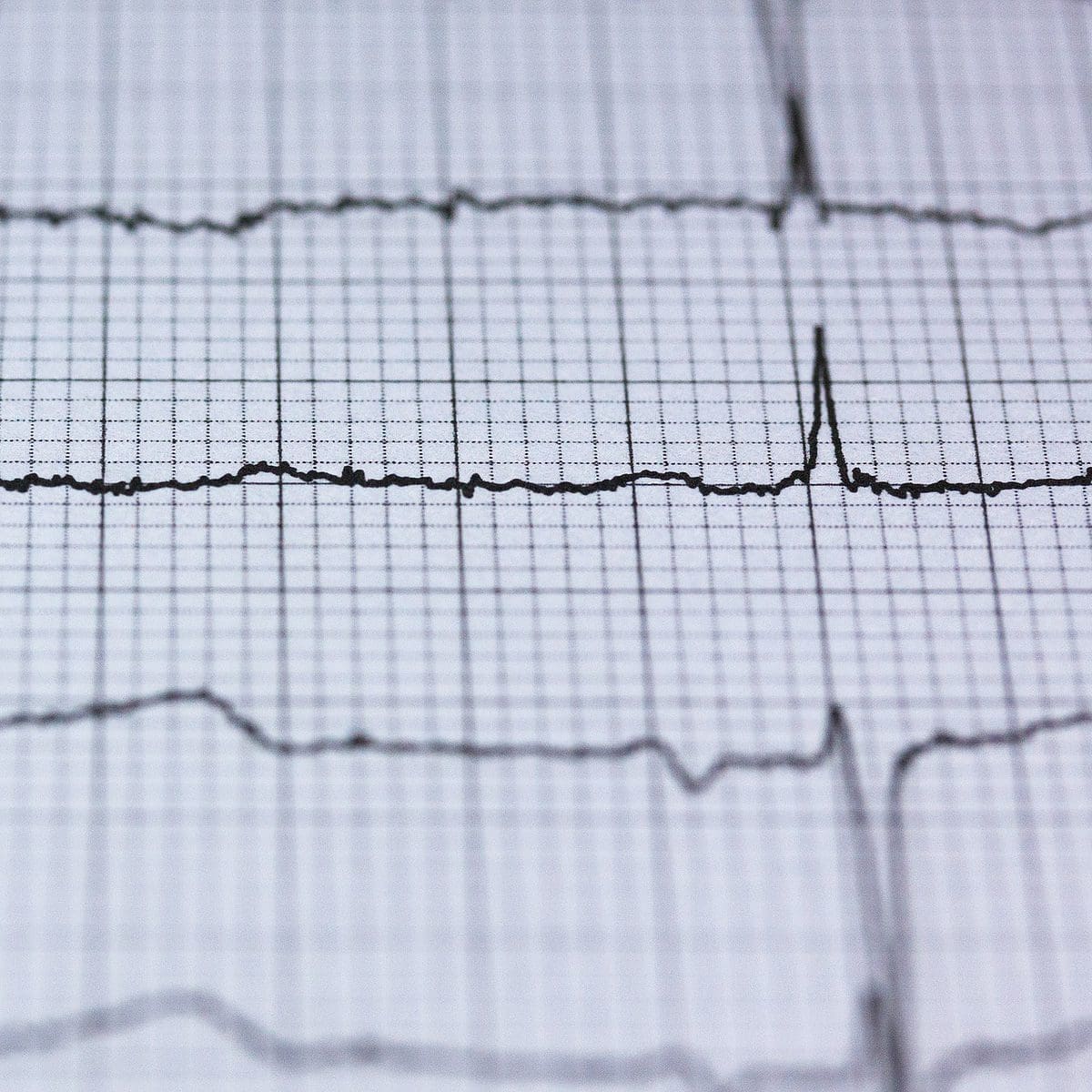 ECG