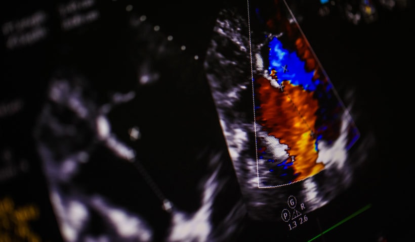 echocardiogram