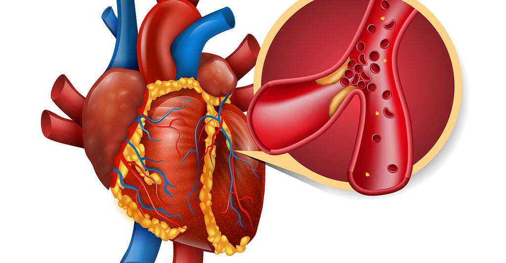 Image of a heart with myocardial infarction