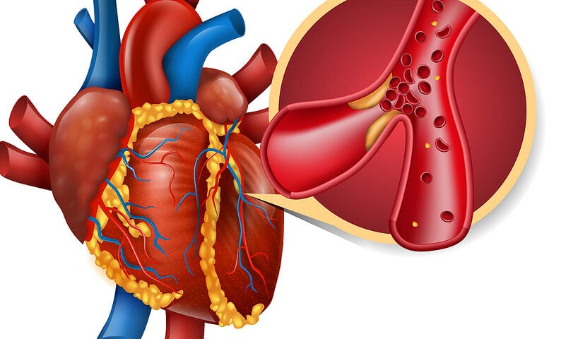 Image of a heart with myocardial infarction