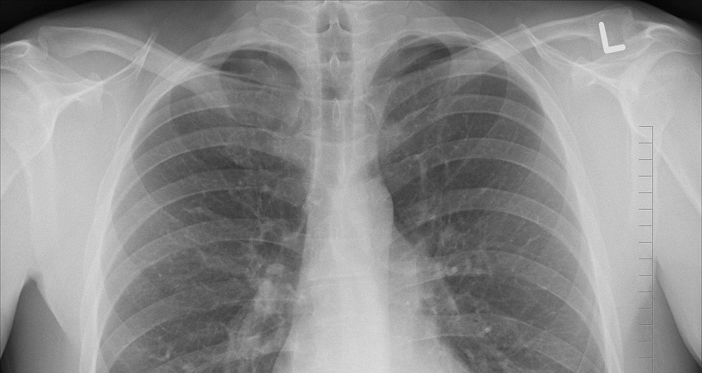 Chest X-ray