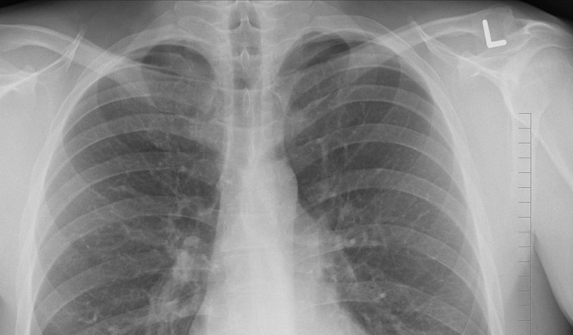 Chest X-ray