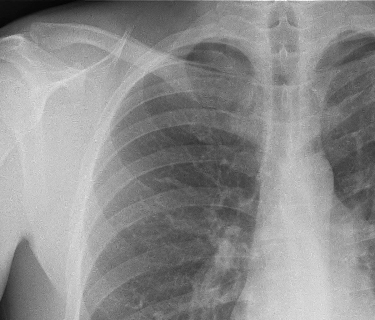 Chest X-ray