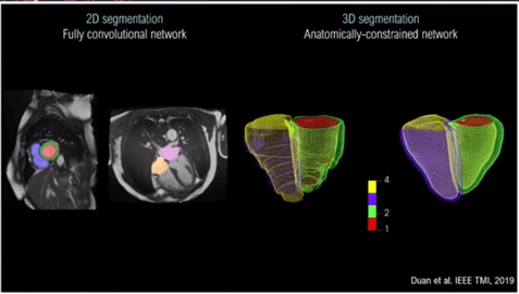 Visualisation of a 3D bi-ventricular model obtained through segmenting the volumetric image.