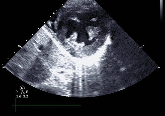 Echocardiogram Hypertension