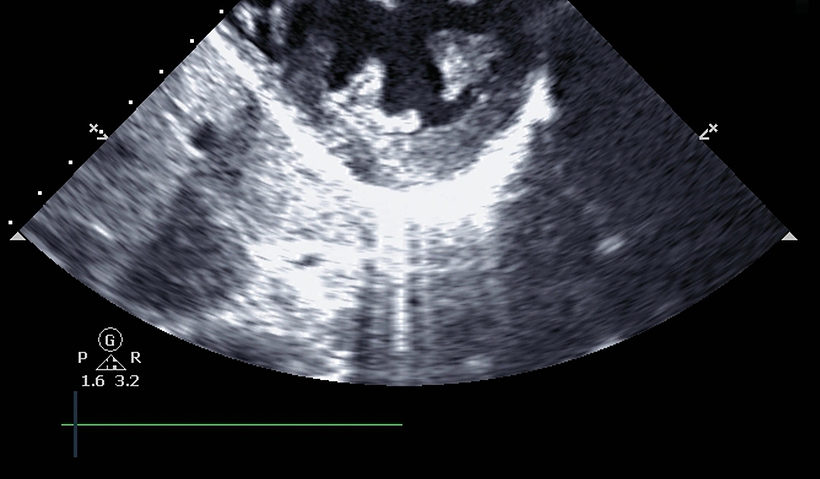 Echocardiogram Hypertension