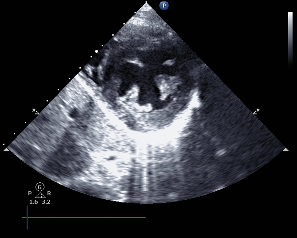 Echocardiogram Hypertension